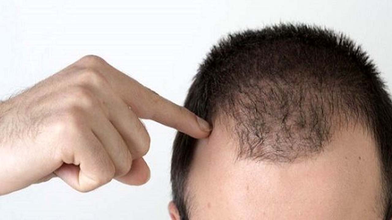 آن‌هایی که ارثی ریزش مو دارند چه کار کنند؟
