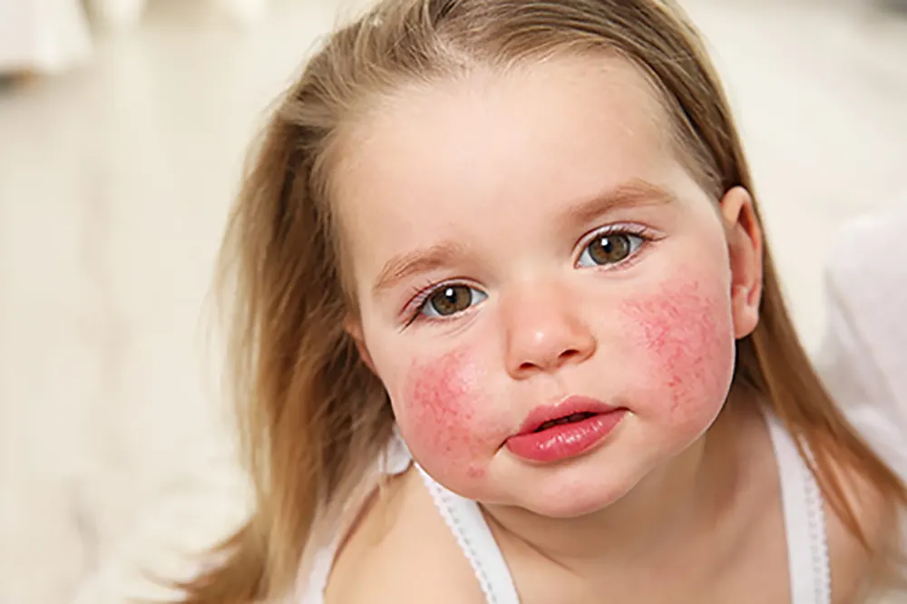 تأثیر لباس بر حساسیت پوستی نوزادان | علائم و راه‌های درمان آن
